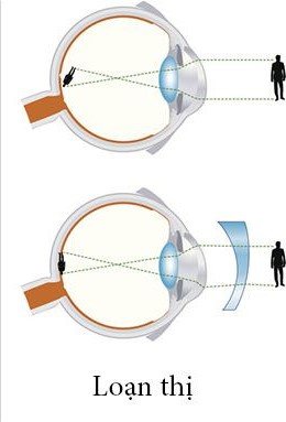 Viễn Thị & Lão Thị — Mắt kính Đức Phương Sóc Trăng