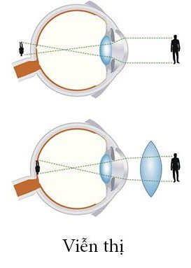 Viễn Thị & Lão Thị — Mắt kính Đức Phương Sóc Trăng