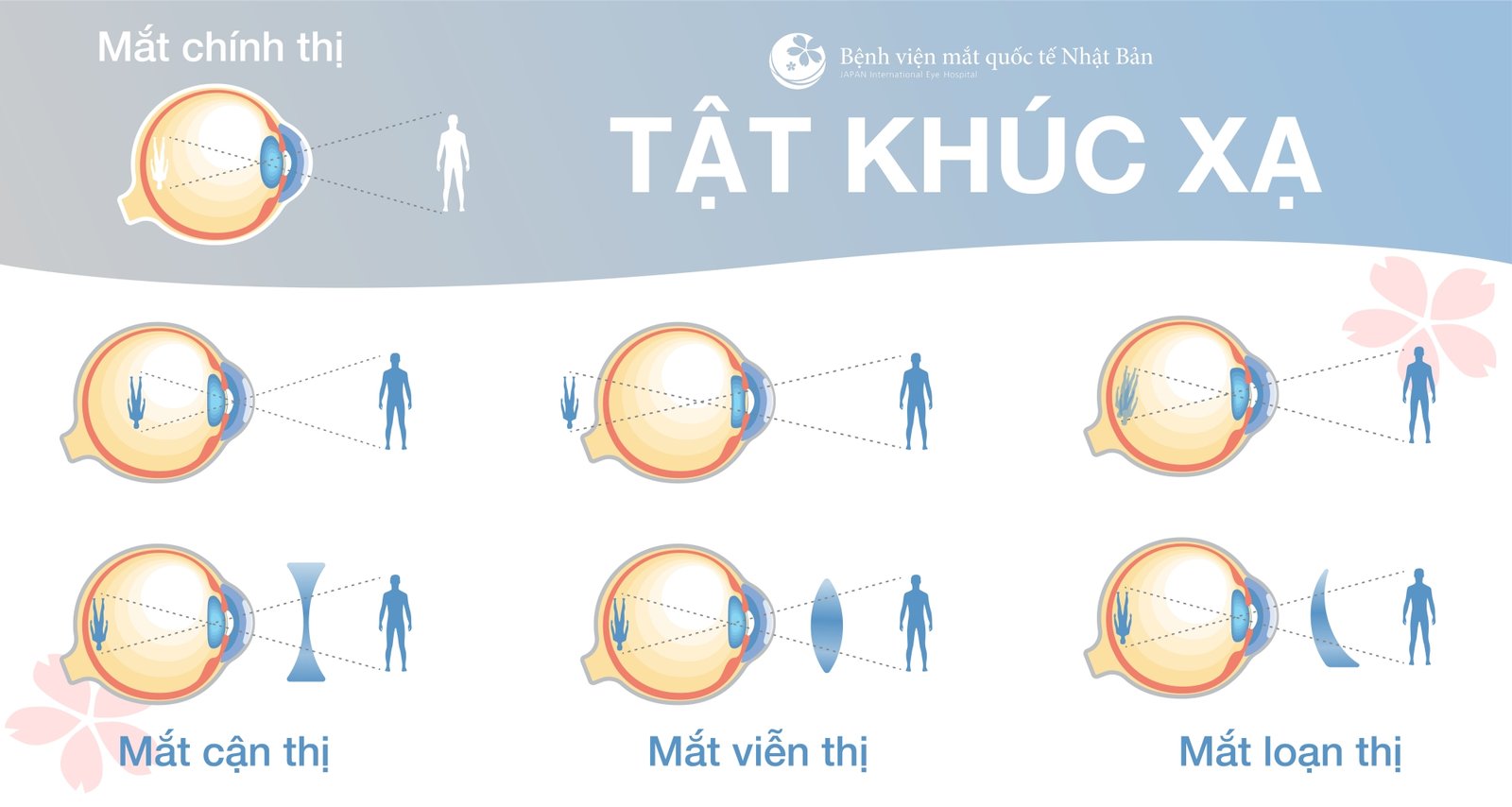 Cận Viễn Loạn khác nhau như thế nào