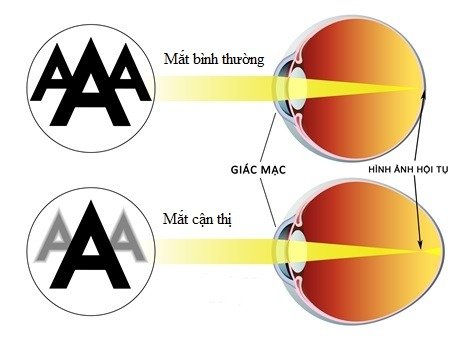 Cận Thị: Hiểu Biết và Giải Pháp Cải Thiện Thị Lực