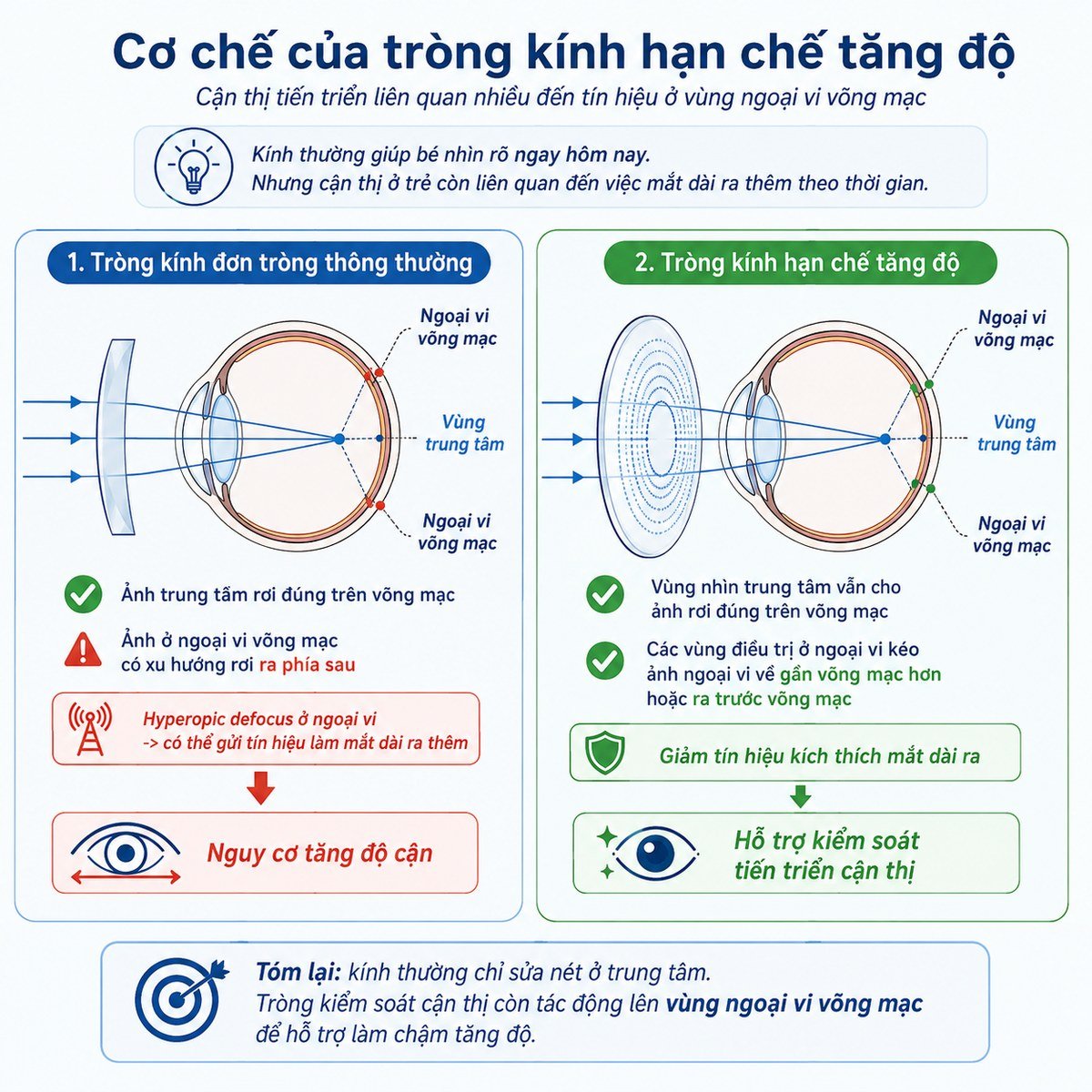 So sánh cơ chế tròng kính đơn tròng thông thường và tròng kính hạn chế tăng độ ở vùng ngoại vi võng mạc