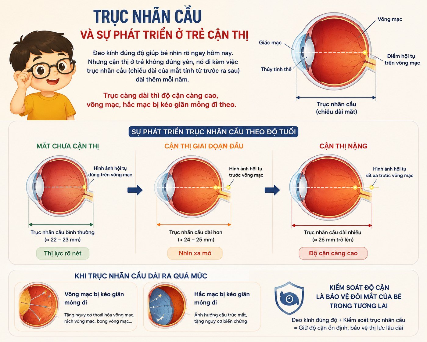 Trục nhãn cầu và sự phát triển ở trẻ cận thị, từ mắt chưa cận 22 tới 23mm, cận giai đoạn đầu 24 tới 25mm, cận nặng từ 26mm trở lên